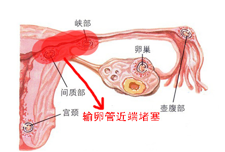 輸卵管堵塞的相關(guān)知識(shí)，大多數(shù)人都不知道這個(gè)！